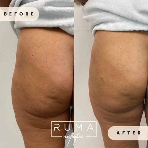 Buttock Enhancement Before and After Images - UT- Ruma Aesthetic