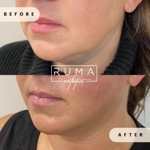 Facial Implants Before and After Images - UT -Ruma Aesthetic