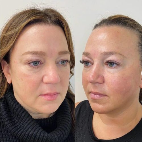 facial wrinkles | Ruma Medical Aesthetics - UT - RumaAesthetic